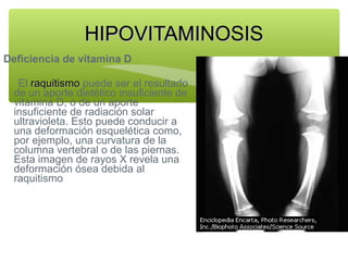 HIPOVITAMINOSIS
Deficiencia de vitamina D
El raquitismo puede ser el resultado
de un aporte dietético insuficiente de
vitamina D, o de un aporte
insuficiente de radiación solar
ultravioleta. Esto puede conducir a
una deformación esquelética como,
por ejemplo, una curvatura de la
columna vertebral o de las piernas.
Esta imagen de rayos X revela una
deformación ósea debida al
raquitismo

 