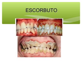 ESCORBUTO

 