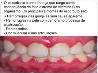  O escorbuto é uma doença que surge como
conseqüência da falta extrema de vitamina C no
organismo. Os principais sintomas do escorbuto são:
- Hemorragias nas gengivas sem causa aparente
- Hemorragias na pele com demora no processo de
cicatrização.
- Dentes soltos
- Dor muscular e nas articulações
- Cansaço.
 