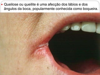  Queilose ou queilite é uma afecção dos lábios e dos
ângulos da boca, popularmente conhecida como boqueira.
 
