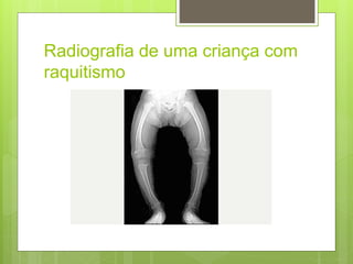 Radiografia de uma criança com
raquitismo
 