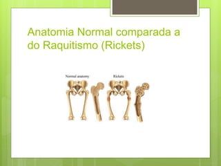 Anatomia Normal comparada a
do Raquitismo (Rickets)
 