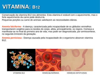 19
VITAMINA:VITAMINA: BB1212
Conservação da vitamina B12 nos alimentos: Esta vitamina é estável com o aquecimento, mas o
forte aquecimento da carne pode destruí-la.
Pequenas porções ou carne de animais satisfazem as necessidades diárias.
Anemia falciforme - A doença, caracterizada pela incapacidade de os glóbulos vermelhos
transportarem oxigênio para os tecidos do corpo, afeta, principalmente, os negros. Começa a
manifestar-se no final do primeiro ano de vida, mas pode ser diagnosticada, por amniocentese,
no segundo trimestre da gestação.
Anemia perniciosa - Doença causada pela incapacidade de o organismo absorver vitamina
B12.
HEMÁCIAS DEFEITUOSASVITAMINA B12 HEMÁCIAS NORMAIS
 