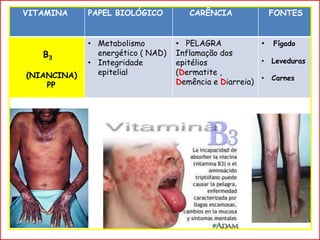 VITAMINA PAPEL BIOLÓGICO CARÊNCIA FONTES
B3
(NIANCINA)
PP
• Metabolismo
energético ( NAD)
• Integridade
epitelial
• PELAGRA
Inflamação dos
epitélios
(Dermatite ,
Demência e Diarreia)
• Fígado
• Leveduras
• Carnes
 
