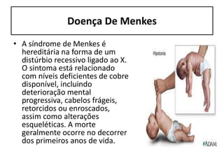 Doença De Menkes
• A síndrome de Menkes é
hereditária na forma de um
distúrbio recessivo ligado ao X.
O sintoma está relacionado
com níveis deficientes de cobre
disponível, incluindo
deterioração mental
progressiva, cabelos frágeis,
retorcidos ou enroscados,
assim como alterações
esqueléticas. A morte
geralmente ocorre no decorrer
dos primeiros anos de vida.
 