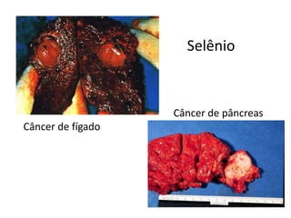 Câncer de fígado
Câncer de pâncreas
Selênio
 