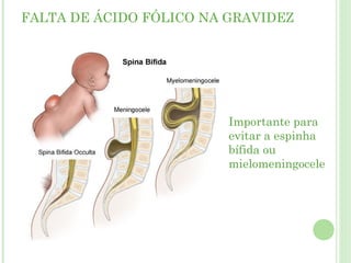 FALTA DE ÁCIDO FÓLICO NA GRAVIDEZ
Importante para
evitar a espinha
bífida ou
mielomeningocele
 