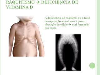 RAQUITISMO  DEFICIÊNCIA DE
VITAMINA D
A deficiência de calciferol ou a falta
de exposição ao sol leva à pouca
absorção de cálcio  mal formação
dos ossos
 