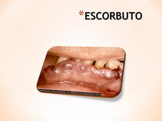 *ESCORBUTO

 