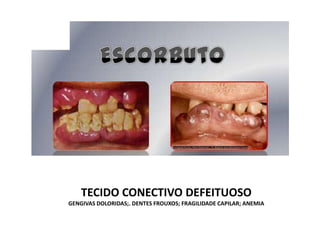 TECIDO CONECTIVO DEFEITUOSO
GENGIVAS DOLORIDAS;. DENTES FROUXOS; FRAGILIDADE CAPILAR; ANEMIA
 