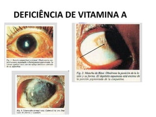 DEFICIÊNCIA DE VITAMINA A
 