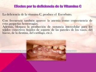 La deficiencia de la vitamina C, produce el Escorbuto.
Con frecuencia también aparece la anemia como consecuencia de
estas pequeñas hemorragias.
Además, bloquea la producción de sustancia intercelular para los
tejidos conectivos (tejidos de soporte de las paredes de los vasos, del
hueso, de la dentina, del cartílago, etc.).
 