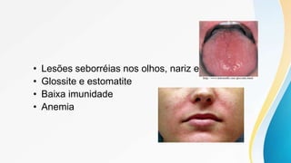 • Lesões seborréias nos olhos, nariz e boca
• Glossite e estomatite
• Baixa imunidade
• Anemia
 