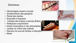 Sintomas
• Hemorragias nasais e bucais
• Amolecimento das gengivas
• Perda dos dentes
• Exaustão e fraqueza
• Inchaço dos braços e pernas (Edema)
• Petéquias e equimoses
• Dores musculares e nas articulações
• Lesões na íntima das artérias
• Demora na cura de feridas e infecções
• Morte
 