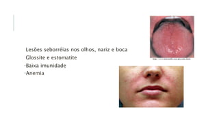 Lesões seborréias nos olhos, nariz e boca
Glossite e estomatite
•Baixa imunidade
•Anemia
 