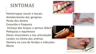 SINTOMAS
Hemorragias nasais e bucais
Amolecimento das gengivas
Perda dos dentes
Exaustão e fraqueza
Inchaço dos braços e pernas (Edema)
Petéquias e equimoses
Dores musculares e nas articulações
Lesões na íntima das artérias
Demora na cura de feridas e infecções
Morte
 