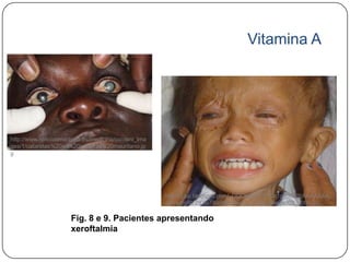 Vitamina A




http://www.noticiasmedicas.es/medicina/content_ima
ges/1/cataratas%20en%20paciente%20mauritano.jp
g




                                                     http://3.bp.blogspot.com/_DDCIeKjLjYI/TDz1gyplUPI/AAAAAAA
                                                     ACLs/zgRYZIDfo78/s1600/tema_7_clip_image002_0000.jpg

                      Fig. 8 e 9. Pacientes apresentando
                      xeroftalmia
 