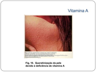 Vitamina A




http://bob.usuhs.mil/biochem/nutrition/images/follicular-
hyperkeratosis-1.jpg


Fig. 10. Queratinização da pele
devido à deficiência de vitamina A
 