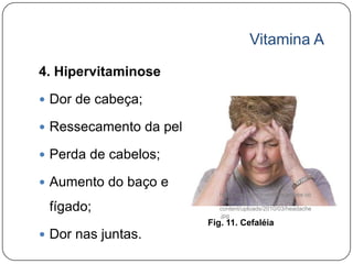 Vitamina A

4. Hipervitaminose

 Dor de cabeça;

 Ressecamento da pele;

 Perda de cabelos;

 Aumento do baço e
                             http://www.mindovermenopause.co
                             m/wp-
 fígado;                     content/uploads/2010/03/headache
                             .jpg
                          Fig. 11. Cefaléia
 Dor nas juntas.
 