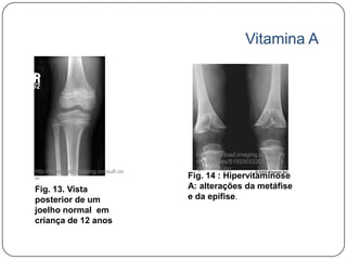 Vitamina A




                                      http://download.imaging.consult.co
                                      m/ic/images/S1933033207760238
http://download.imaging.consult.co    /gr14-midi.jpg
m                                    Fig. 14 : Hipervitaminose
Fig. 13. Vista                       A: alterações da metáfise
posterior de um                      e da epífise.
joelho normal em
criança de 12 anos
 