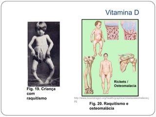 Vitamina D




http://www.ferato.com/wi
ki/images/2/2b/2008121
2_mgb_Raquitismo_.jpg
Fig. 19. Criança
com
raquitismo                 http://www.moondragon.org/health/graphics/ricketsosteomalacia.j
                           pg
                                       Fig. 20. Raquitismo e
                                       osteomalácia
 