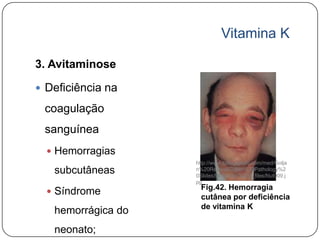 Vitamina K

3. Avitaminose

 Deficiência na

 coagulação
 sanguínea
   Hemorragias
                    http://www.italiagigliotti.com/med/Golja
   subcutâneas      n%20Review/Goljan%20Pathology%2
                    0Slides/9/nutrition%201_files/Nut009.j
                    pg
                      Fig.42. Hemorragia
   Síndrome
                      cutânea por deficiência
                      de vitamina K
   hemorrágica do
   neonato;
 