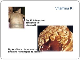 Vitamina K


                            Fig. 43. Criança com
                            deficiência em
 http://www.pediatriconca
 ll.com/cgi_bin/Vitamin%    vitamina K
 20K%20deficiency.jpg




Fig. 44. Cérebro de neonato comhttp://www.italiagigliotti.com/med
Síndrome Hemorrágica do Neonato.
 
