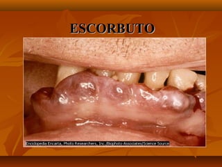ESCORBUTO

 