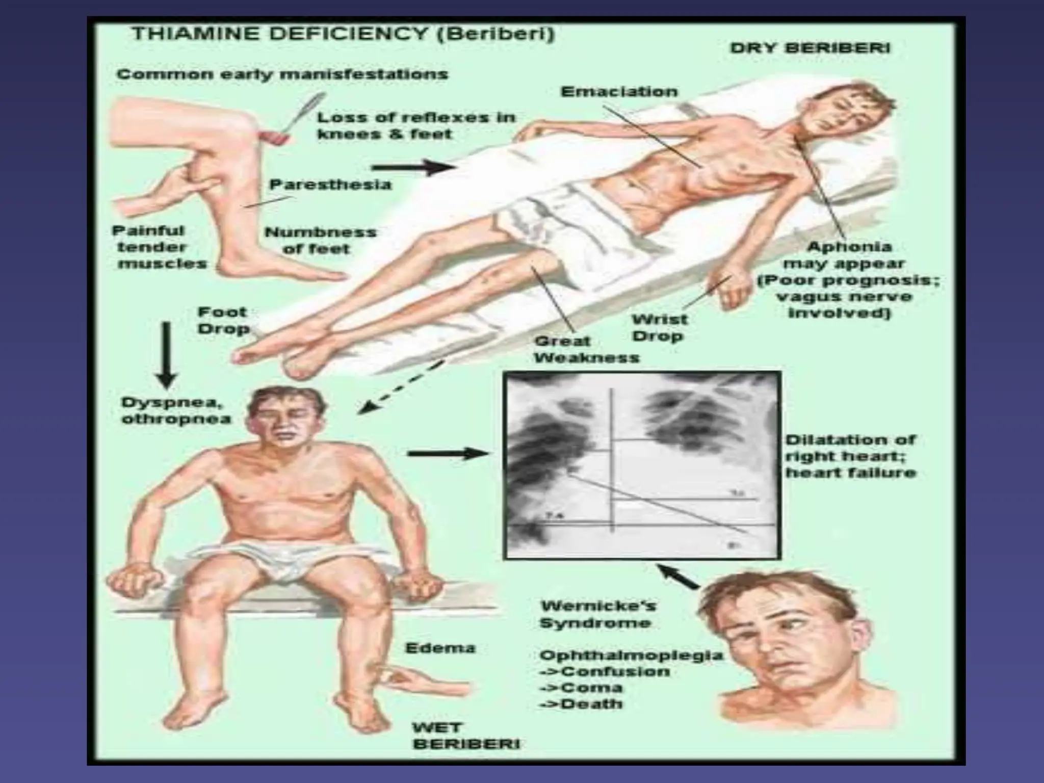 VITAMIN B1 - THIAMINE Functions, Food Sources and Deficiency | PPT