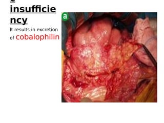 c
insufficie
ncy
It results in excretion
of cobalophilin
 