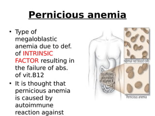 Pernicious anemia
• Type of
megaloblastic
anemia due to def.
of INTRINSIC
FACTOR resulting in
the failure of abs.
of vit.B12
• It is thought that
pernicious anemia
is caused by
autoimmune
reaction against
 