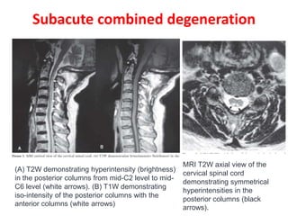 Subacute combined degeneration
(A) T2W demonstrating hyperintensity (brightness)
in the posterior columns from mid-C2 level to mid-
C6 level (white arrows). (B) T1W demonstrating
iso-intensity of the posterior columns with the
anterior columns (white arrows)
MRI T2W axial view of the
cervical spinal cord
demonstrating symmetrical
hyperintensities in the
posterior columns (black
arrows).
 