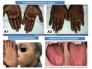 HYPERPIGMENTATION OF HANDS
RETICULATE PIGMENTAION TONGUE IN VITB12 DEFICIENCY
 