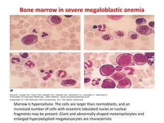 Bone marrow in severe megaloblastic anemia
Marrow is hypercellular. The cells are larger than normoblasts, and an
increased number of cells with eccentric lobulated nuclei or nuclear
fragments may be present .Giant and abnormally shaped metamyelocytes and
enlarged hyperpolyploid megakaryocytes are characteristic
 