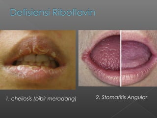 1. cheilosis (bibir meradang) 2. Stomatitis Angular
 