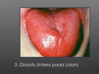 3. Glosistis (Infeksi pada Lidah)
 
