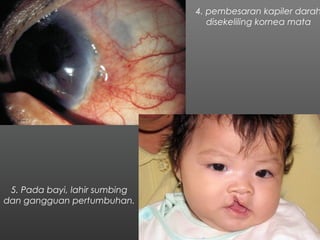 4. pembesaran kapiler darah
disekeliling kornea mata
5. Pada bayi, lahir sumbing
dan gangguan pertumbuhan.
 