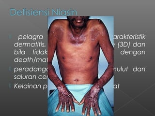  pelagra yang mempunyai karakteristik
dermatitis, demensia, dan diare (3D) dan
bila tidak ditangani diakhiri dengan
death/mati (4D).
 peradangan pada mukosa mulut dan
saluran cerna , diare
 Kelainan pada system saraf pusat
 
