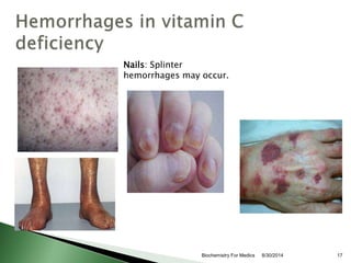 Nails: Splinter 
hemorrhages may occur. 
Biochemistry For Medics 8/30/2014 17 
 