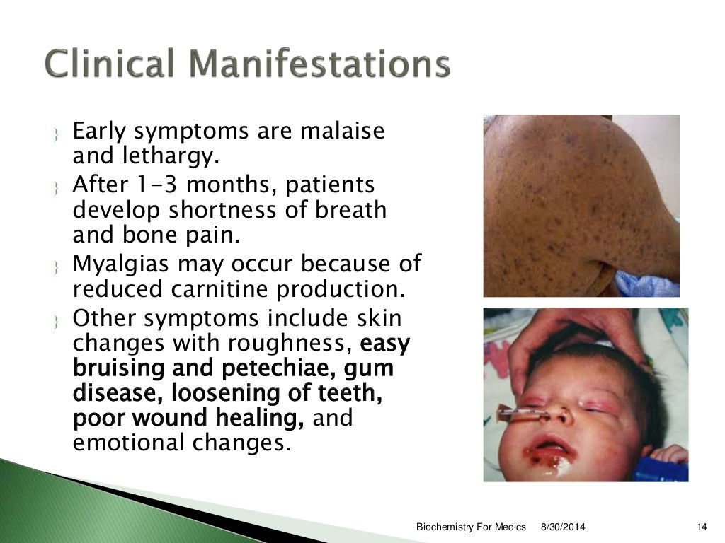 Vitamin C deficiency