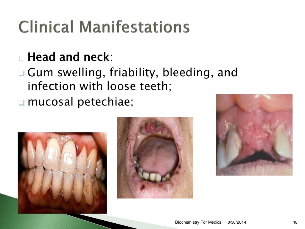 Vitamin C deficiency