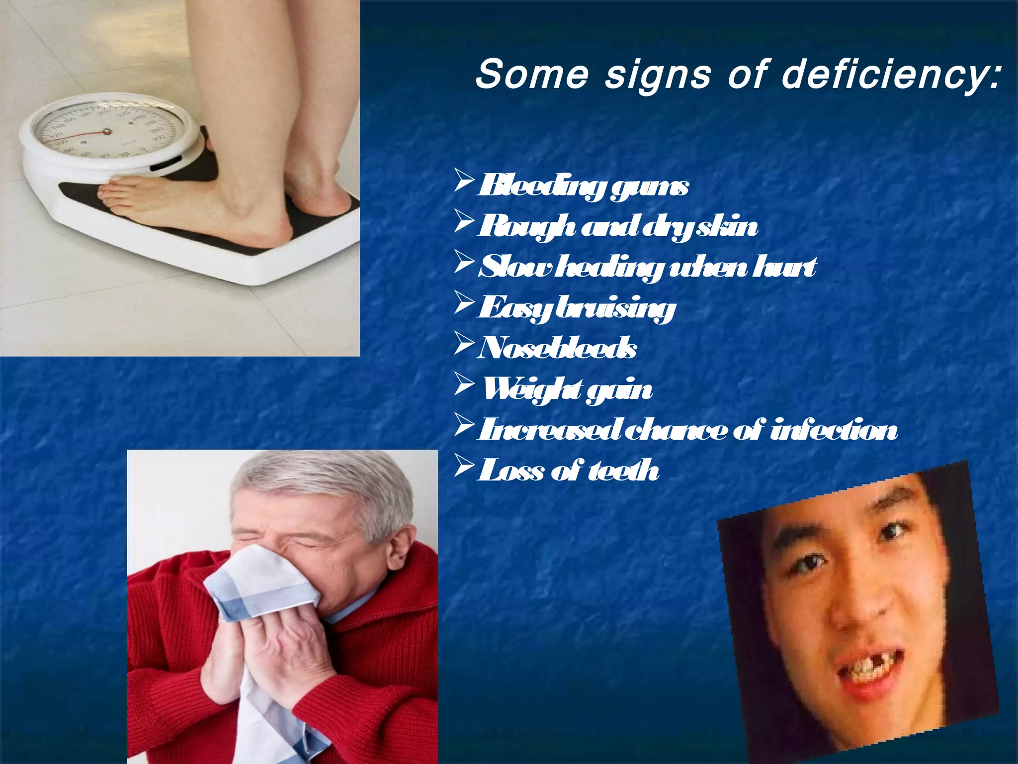 Some signs of deficiency:
Bleeding gum
s
Rough and dryskin
Slow healing when hurt
Easybruising
Nosebleeds
W
eight gain
Increased chance of infection
Loss of teeth

 