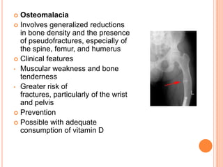  Osteomalacia
 Involves generalized reductions
  in bone density and the presence
  of pseudofractures, especially of
  the spine, femur, and humerus
 Clinical features
• Muscular weakness and bone
  tenderness
• Greater risk of
  fractures, particularly of the wrist
  and pelvis
 Prevention
 Possible with adequate
  consumption of vitamin D
 