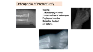 Osteopenia of Prematurity
Staging:
1. Hypodensity of bones
2. Abnormalities of metaphyses
Fraying and cupping
Dense line (healing)
3. Fractures
Courtesy of Steve Abrams MD
 