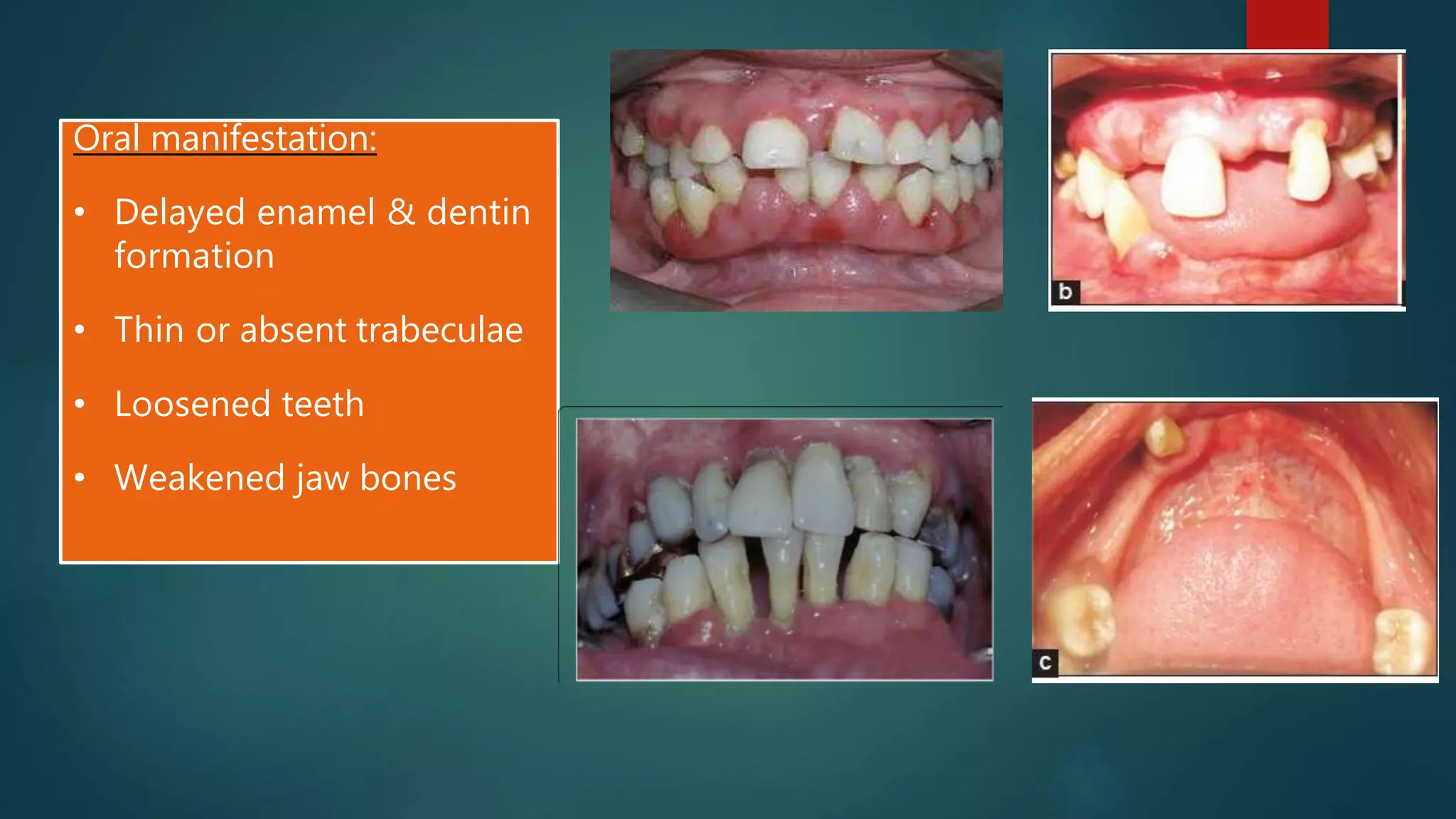 Oral manifestation:
• Delayed enamel & dentin
formation
• Thin or absent trabeculae
• Loosened teeth
• Weakened jaw bones
 