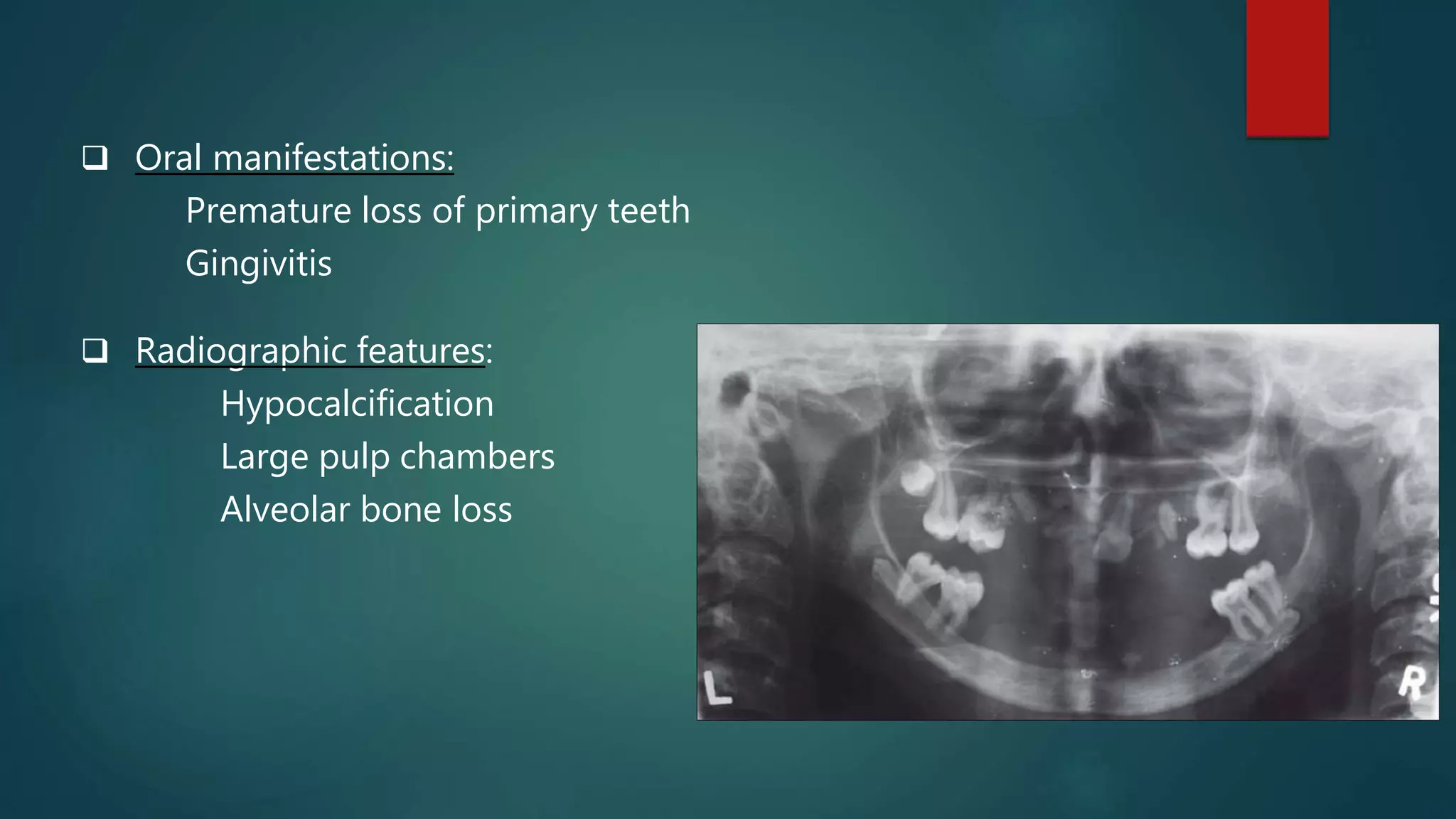  Oral manifestations:
Premature loss of primary teeth
Gingivitis
 Radiographic features:
Hypocalcification
Large pulp chambers
Alveolar bone loss
 
