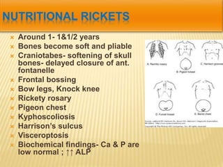  Around 1- 1&1/2 years
 Bones become soft and pliable
 Craniotabes- softening of skull
bones- delayed closure of ant.
fontanelle
 Frontal bossing
 Bow legs, Knock knee
 Rickety rosary
 Pigeon chest
 Kyphoscoliosis
 Harrison’s sulcus
 Visceroptosis
 Biochemical findings- Ca & P are
low normal ; ↑↑ ALP
 