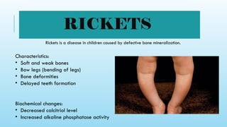 Rickets Overview Comprehensive Overview of Vitamin D: Chemistry, Metabolism, and Health ...