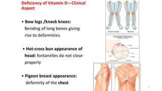 Deficiency of Vitamin D—Clinical
Aspect
• Bow legs /knock knees:
Bending of long bones giving
rise to deformities.
• Hot-cross bun appearance of
head: fontanelles do not close
properly
• Pigeon breast appearance:
deformity of the chest
13
 