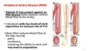 Peripheral Artery Disease (PAD)
• Vitamin D may protect against an
PAD disease (fatty deposits restrict
blood flow to the limbs)
• Individuals with low levels of vit-D
experience an increase risk of PAD.
• Most often reduces blood flow to
the legs causing
pains,
numbness,
impairing the ability to work and
may lead to amputation. 23
 